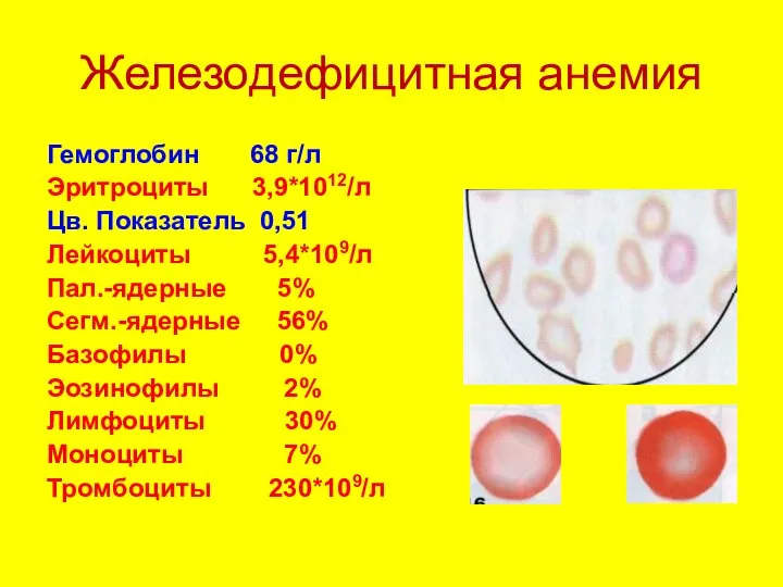 Железодефицитная анемия Гемоглобин 68 г/л Эритроциты 3,9*1012/л Цв. Показатель 0,51 Лейкоциты