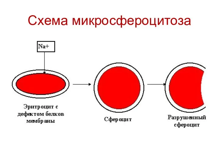 Схема микросфероцитоза