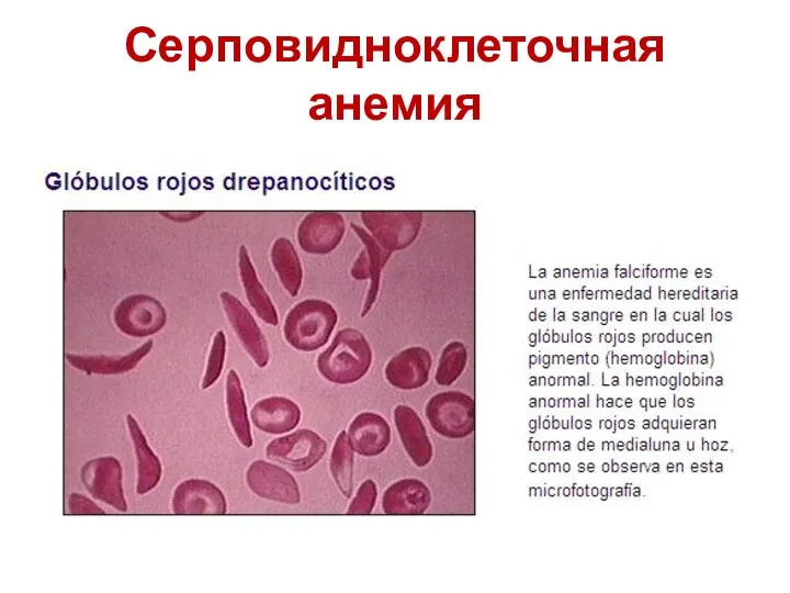 Серповидноклеточная анемия
