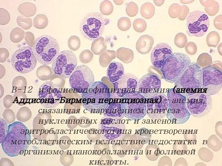 В-12 и фолиеводефицитная анемия (анемия Аддисона-Бирмера пернициозная) – анемия, связанная с