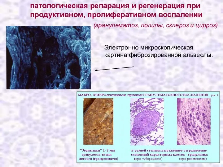 патологическая репарация и регенерация при продуктивном, пролиферативном воспалении Электронно-микроскопическая картина фиброзированной
