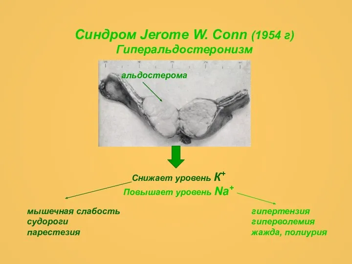 Синдром Jerome W. Conn (1954 г) Гиперальдостеронизм альдостерома Снижает уровень К+