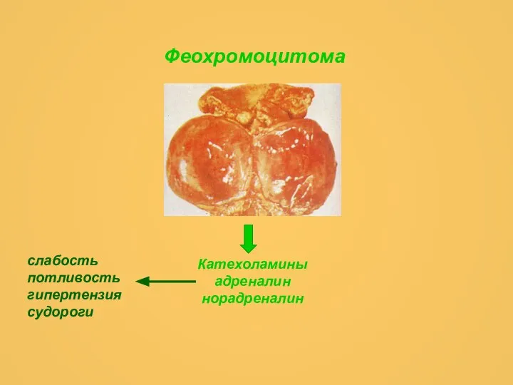 Феохромоцитома Катехоламины адреналин норадреналин слабость потливость гипертензия судороги