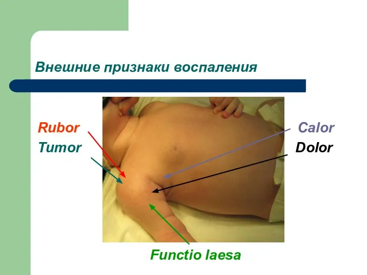 Внешние признаки воспаления Rubor Calor Tumor Dolor Functio laesa