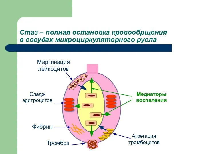 Стаз – полная остановка кровообрщения в сосудах микроциркуляторного русла Маргинация лейкоцитов