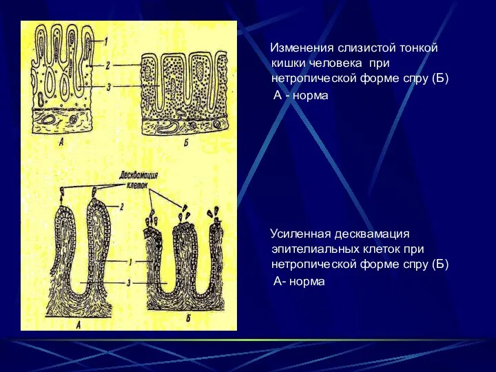 Изменения слизистой тонкой кишки человека при нетропической форме спру (Б) А