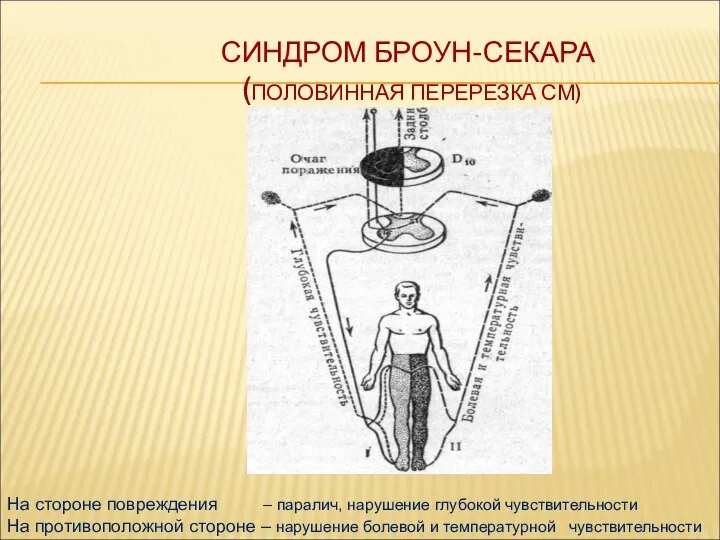 СИНДРОМ БРОУН-СЕКАРА (ПОЛОВИННАЯ ПЕРЕРЕЗКА СМ) На стороне повреждения – паралич, нарушение