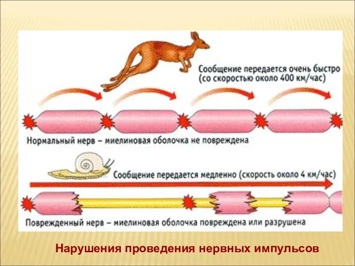 Нарушения проведения нервных импульсов