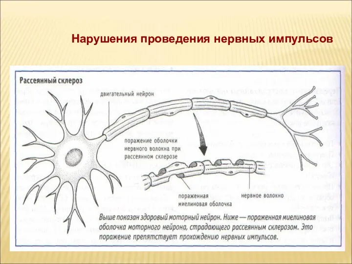 Нарушения проведения нервных импульсов