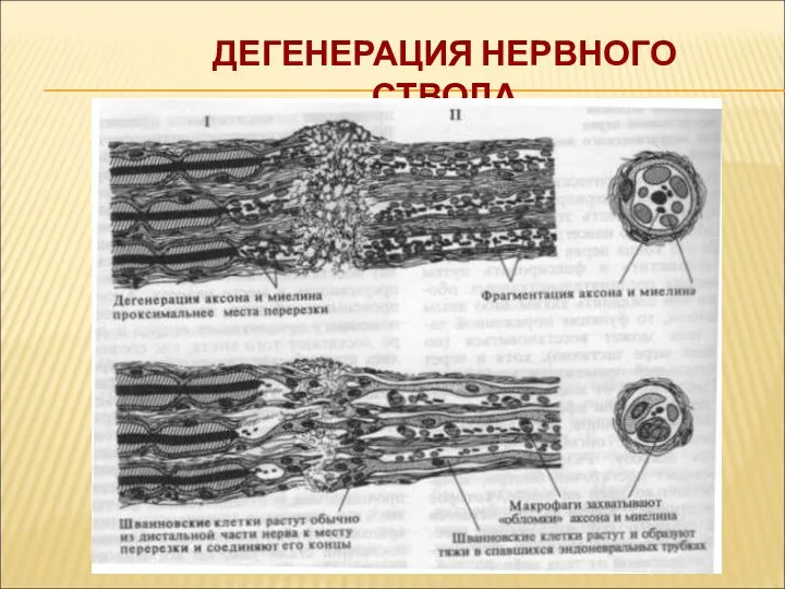 ДЕГЕНЕРАЦИЯ НЕРВНОГО СТВОЛА