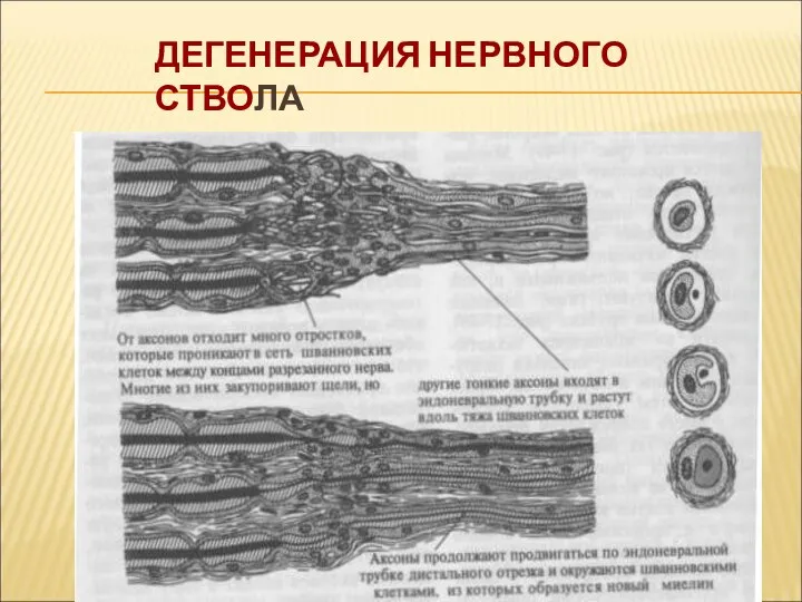 ДЕГЕНЕРАЦИЯ НЕРВНОГО СТВОЛА