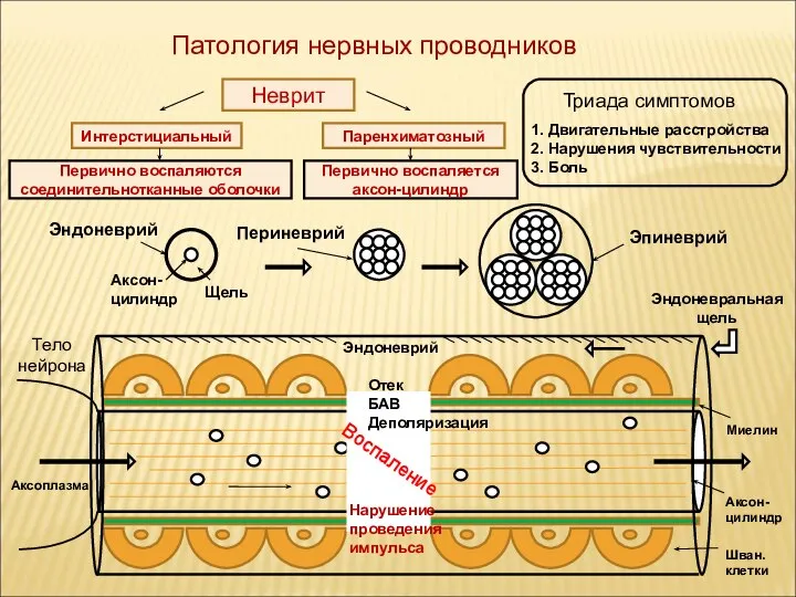 Патология нервных проводников Неврит Интерстициальный Паренхиматозный Тело нейрона Аксон- цилиндр Миелин