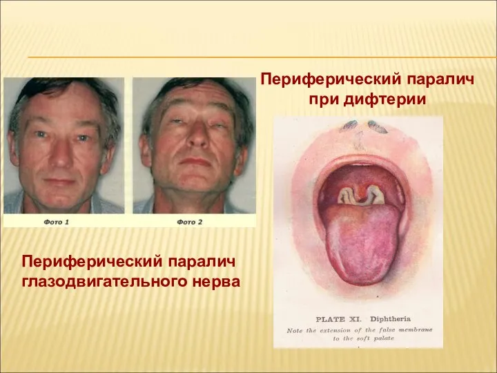 Периферический паралич глазодвигательного нерва Периферический паралич при дифтерии