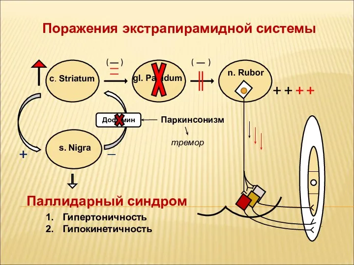 Поражения экстрапирамидной системы n. Rubor gl. Pallidum c. Striatum ( )