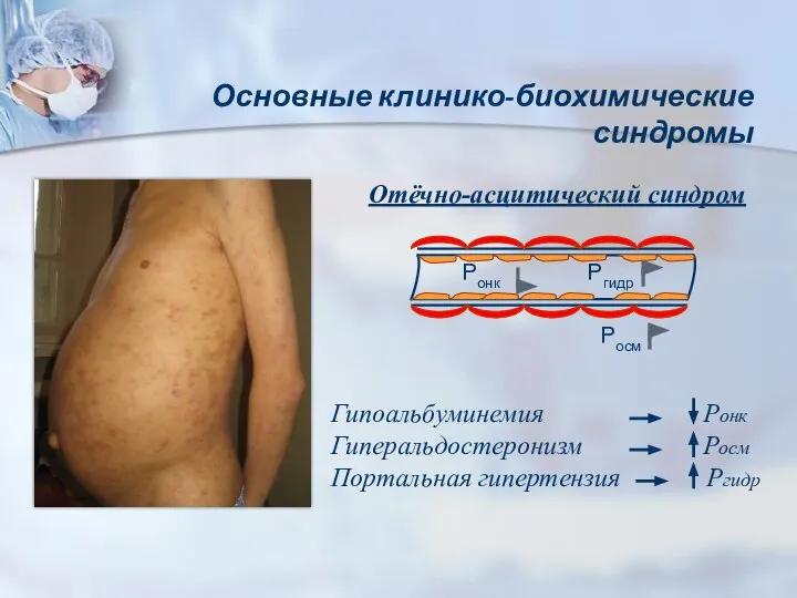 Основные клинико-биохимические синдромы Отёчно-асцитический синдром Ронк Ргидр Росм Гипоальбуминемия Ронк Гиперальдостеронизм Росм Портальная гипертензия Ргидр