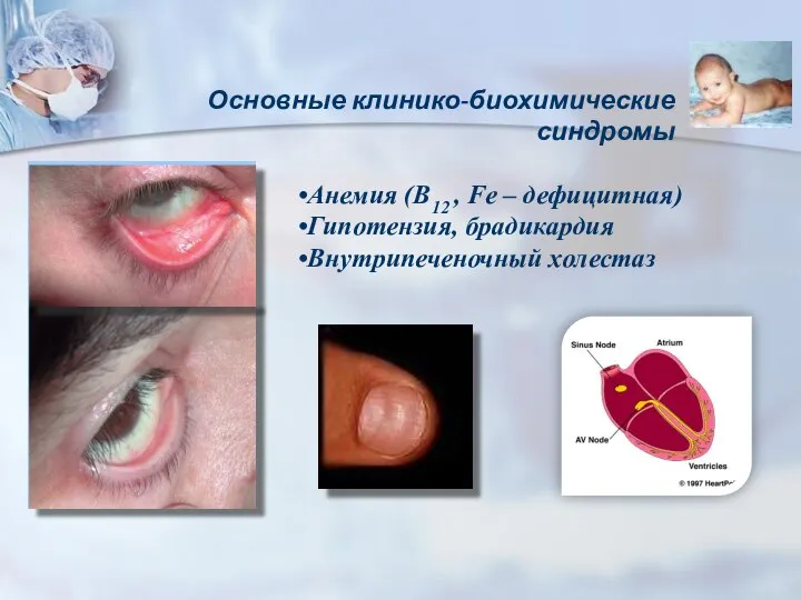 Основные клинико-биохимические синдромы Анемия (В12 , Fe – дефицитная) Гипотензия, брадикардия Внутрипеченочный холестаз