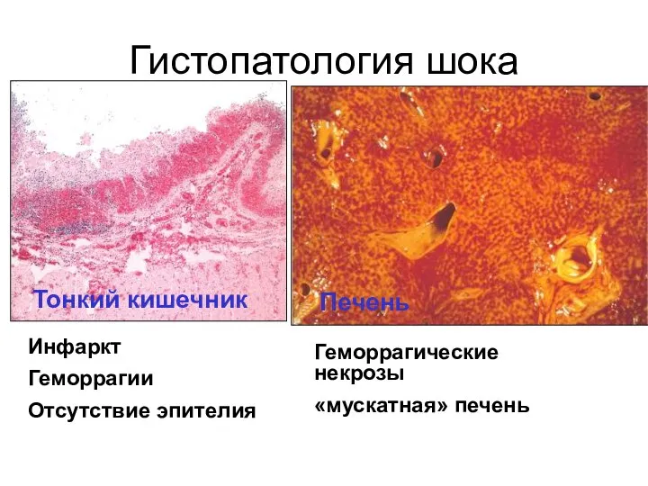 Гистопатология шока