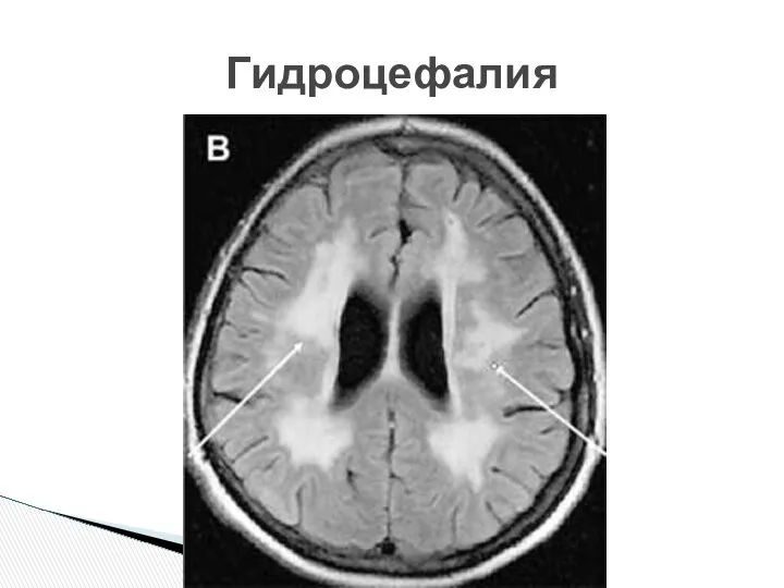 Гидроцефалия