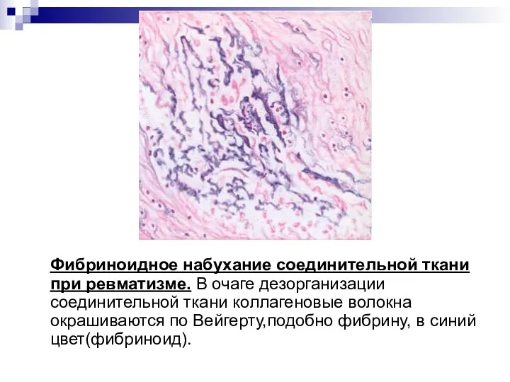 Фибриноидное набухание соединительной ткани при ревматизме. В очаге дезорганизации соединительной ткани