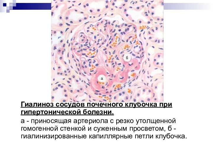 Гиалиноз сосудов почечного клубочка при гипертонической болезни. а - приносящая артериола