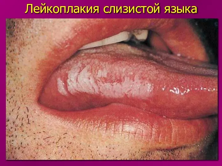 Лейкоплакия слизистой языка