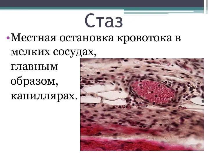 Стаз Местная остановка кровотока в мелких сосудах, главным образом, капиллярах.