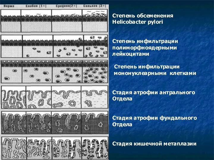 Степень обсеменения Helicobacter pylori Степень инфильтрации полиморфноядерными лейкоцитами Степень инфильтрации мононуклеарными