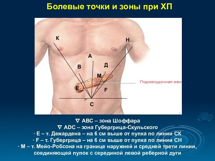 Болевые точки и зоны при ХП ∇ АВС – зона Шоффара