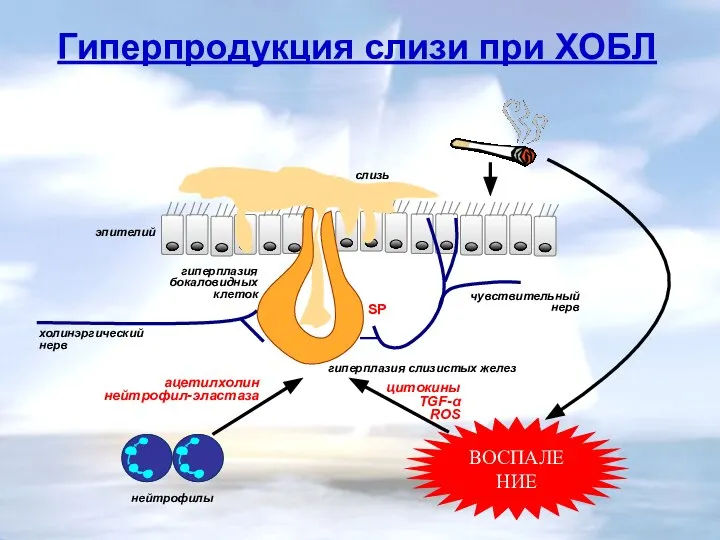 SP гиперплазия бокаловидных клеток слизь холинэргический нерв ацетилхолин нейтрофил-эластаза нейтрофилы эпителий
