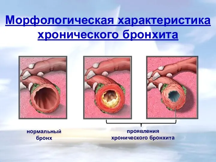 Морфологическая характеристика хронического бронхита