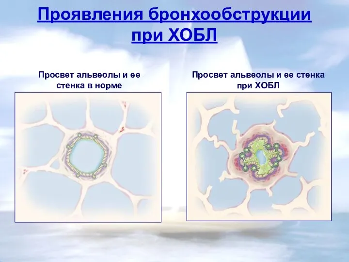 Проявления бронхообструкции при ХОБЛ Просвет альвеолы и ее стенка в норме