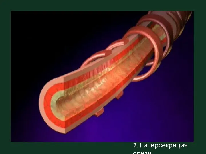 2. Гиперсекреция слизи