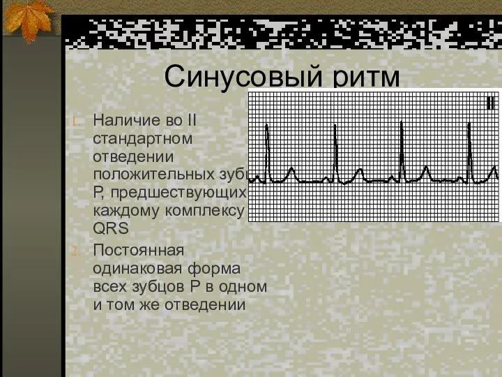 Синусовый ритм Наличие во II стандартном отведении положительных зубцов Р, предшествующих