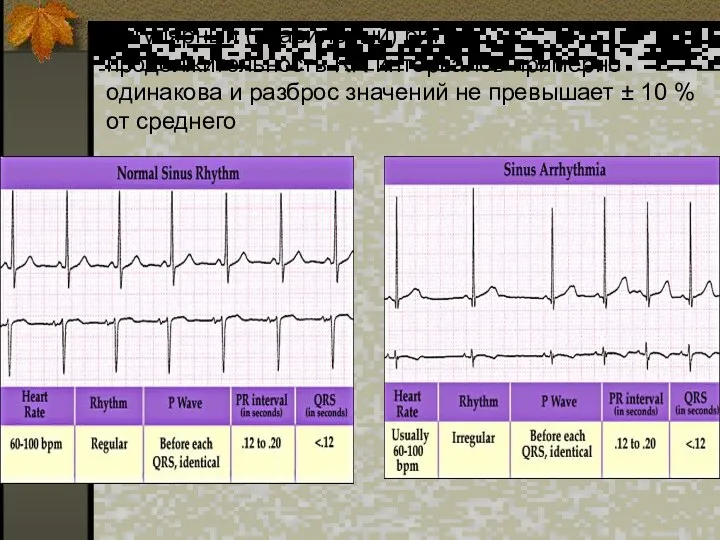 Регулярный (правильный) ритм – продолжительность RR интервалов примерно одинакова и разброс