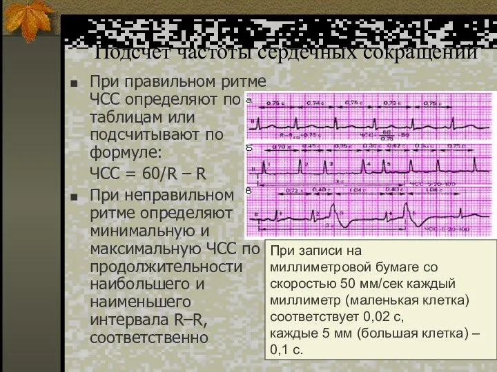 Подсчет частоты сердечных сокращений При правильном ритме ЧСС определяют по таблицам