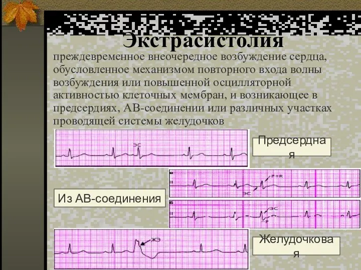 Экстрасистолия преждевременное внеочередное возбуждение сердца, обусловленное механизмом повторного входа волны возбуждения