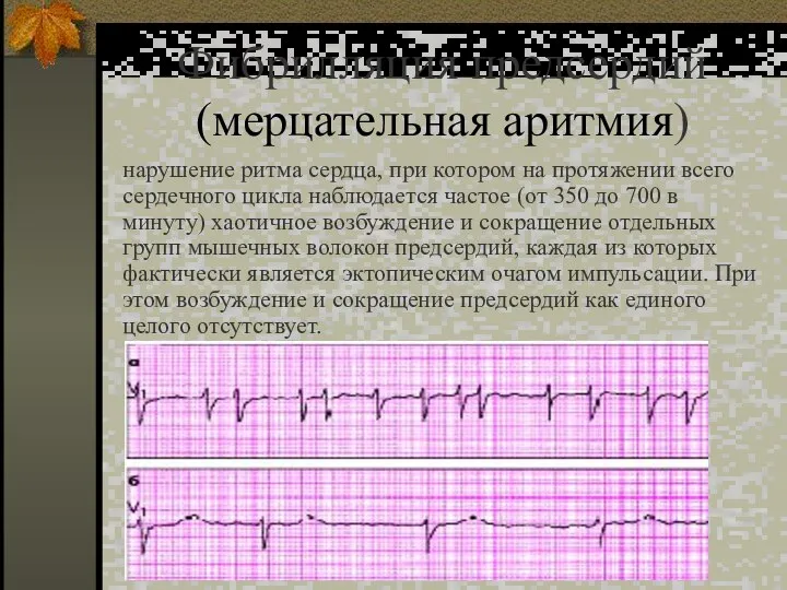 Фибрилляция предсердий (мерцательная аритмия) нарушение ритма сердца, при котором на протяжении