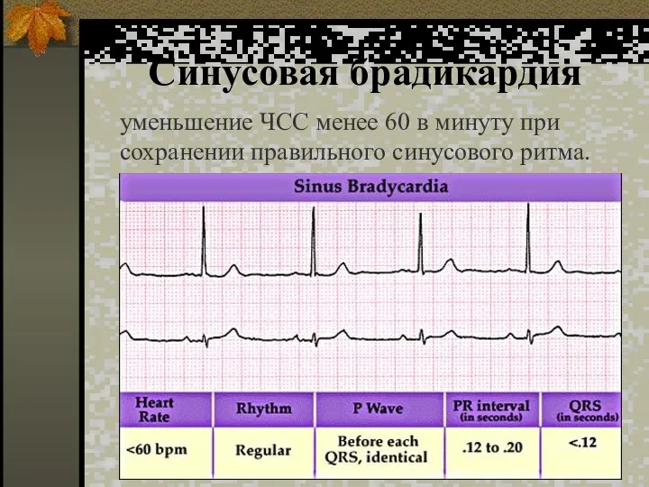 Синусовая брадикардия уменьшение ЧСС менее 60 в минуту при сохранении правильного синусового ритма.