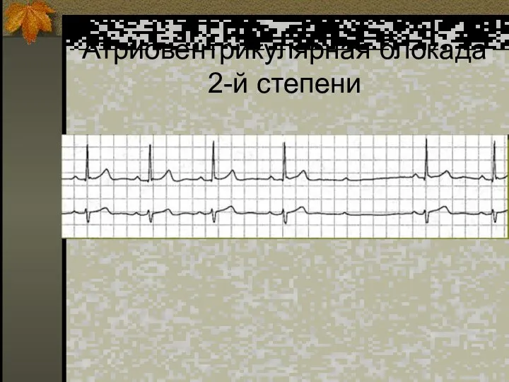 Атриовентрикулярная блокада 2-й степени