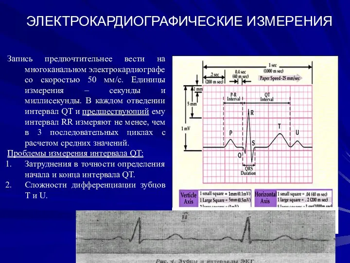 ЭЛЕКТРОКАРДИОГРАФИЧЕСКИЕ ИЗМЕРЕНИЯ Запись предпочтительнее вести на многоканальном электрокардиографе со скоростью 50