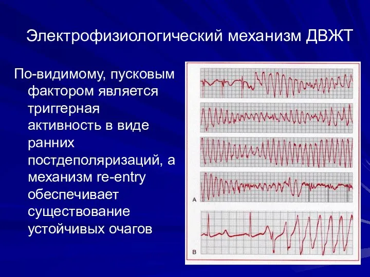 Электрофизиологический механизм ДВЖТ По-видимому, пусковым фактором является триггерная активность в виде