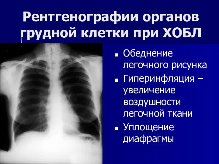 Рентгенографии органов грудной клетки при ХОБЛ Обеднение легочного рисунка Гиперинфляция –