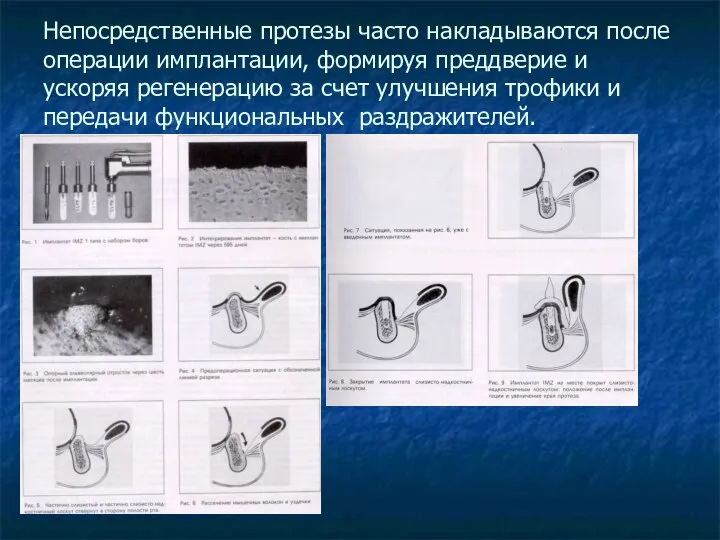 Непосредственные протезы часто накладываются после операции имплантации, формируя преддверие и ускоряя