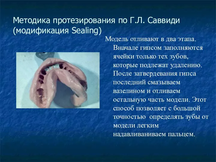 Методика протезирования по Г.Л. Саввиди (модификация Sealing) Модель отливают в два