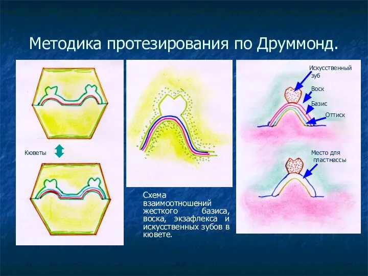 Методика протезирования по Друммонд. Схема взаимоотношений жесткого базиса, воска, экзафлекса и