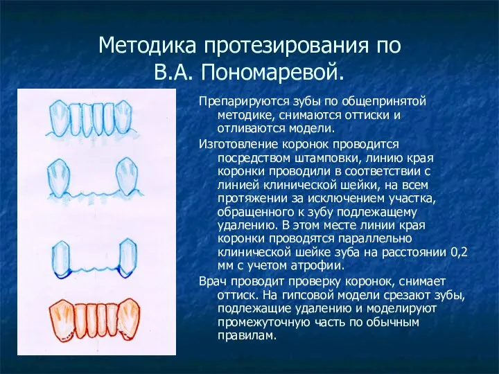 Методика протезирования по В.А. Пономаревой. Препарируются зубы по общепринятой методике, снимаются