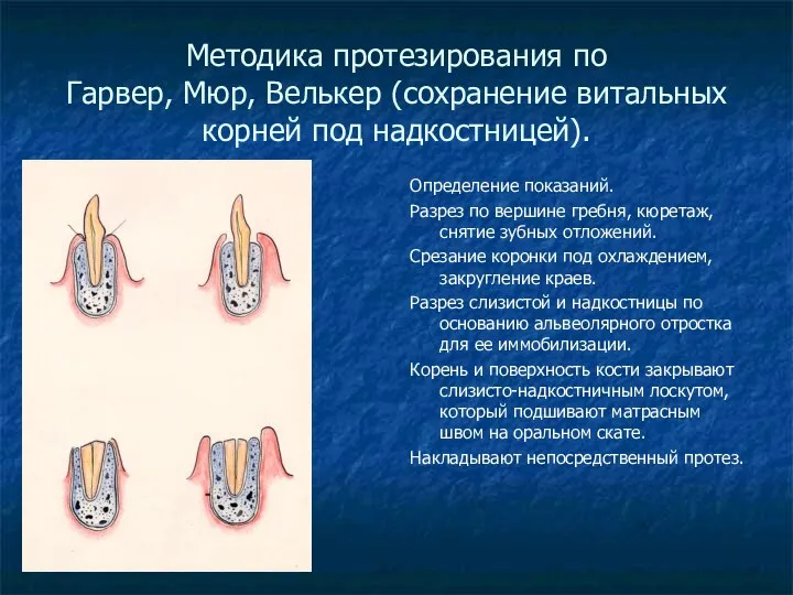 Методика протезирования по Гарвер, Мюр, Велькер (сохранение витальных корней под надкостницей).