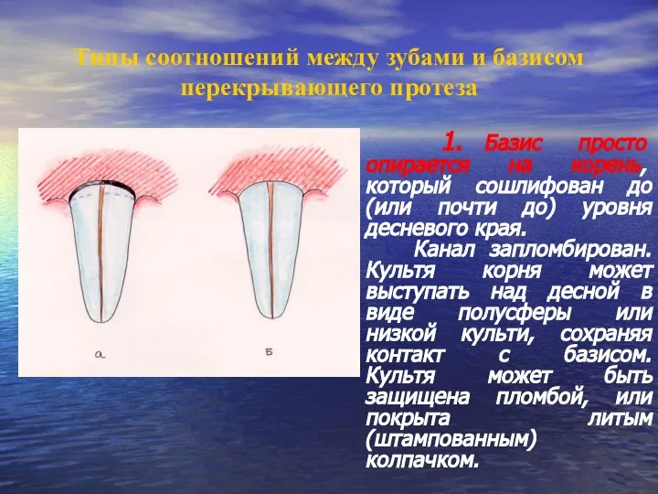 Типы соотношений между зубами и базисом перекрывающего протеза 1. Базис просто