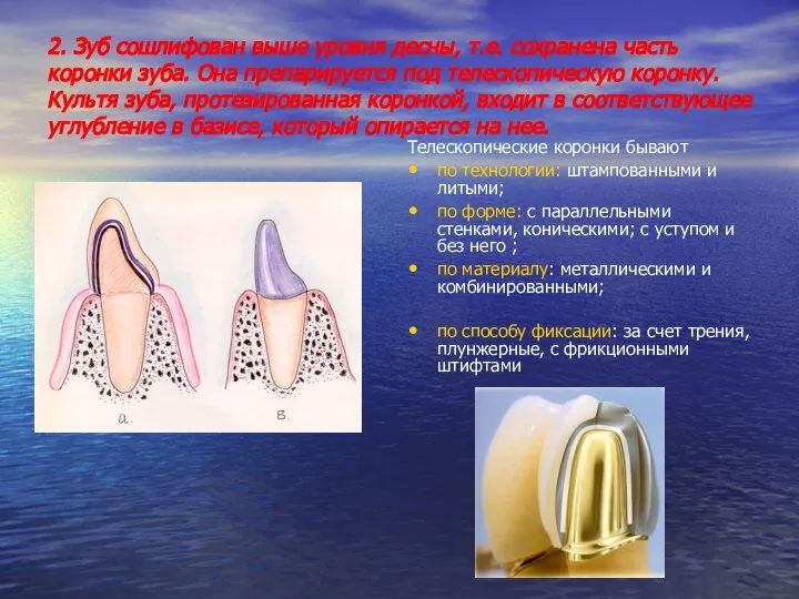 2. Зуб сошлифован выше уровня десны, т.е. сохранена часть коронки зуба.