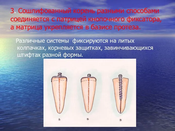 3. Сошлифованный корень разными способами соединяется с патрицей кнопочного фиксатора, а